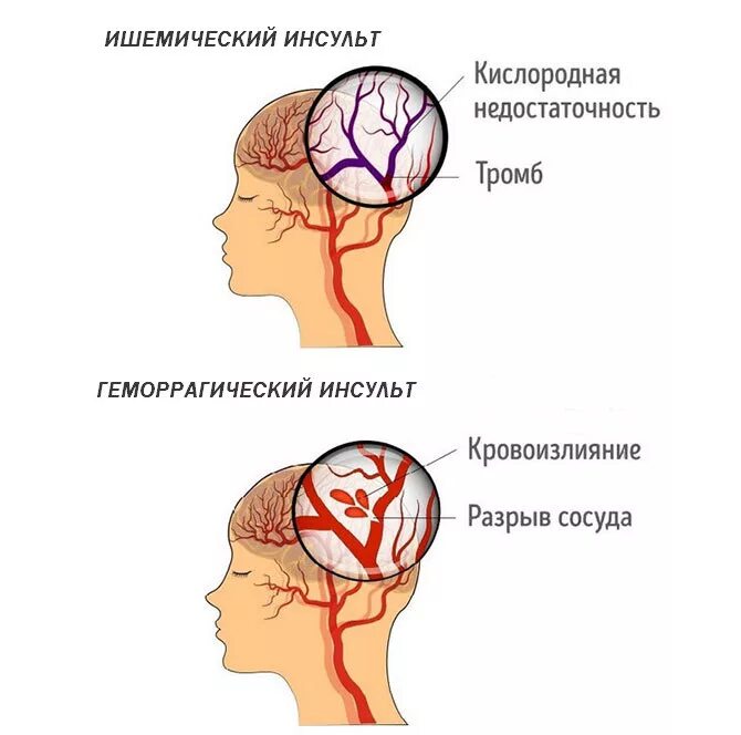Давит левую сторону головы