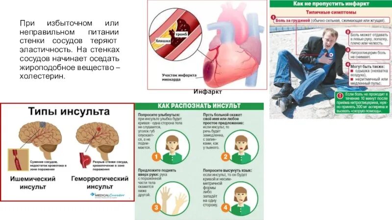 Инсульт холестерин. Атеросклероз инсульт инфаркт. Инсульт и инфаркт. Презентация на тему инсульт и инфаркт.