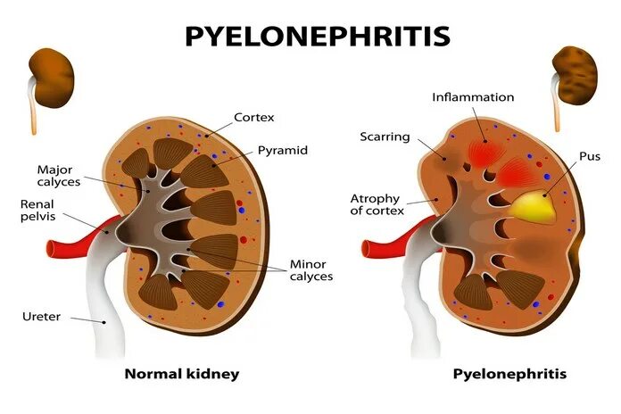 Сильный пиелонефрит. Pyelonephritis Symptoms. Causes of secondary Pyelonephritis.