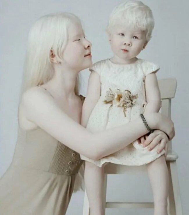 Сноу альбинос сериал. Екатерина симакова дети альбиносы. Глаза альбиноса человека. Дети альбиносы. Как попасть над деревней альбиносов.