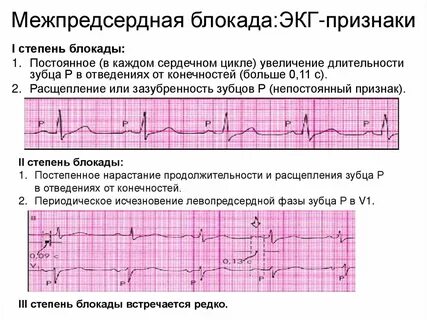 Фибрилляция причины