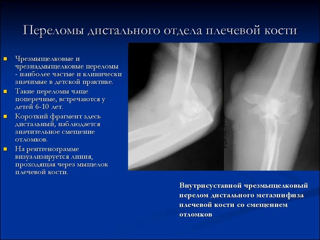 Классификация переломов дистального отдела плечевой кости. Перелом дистального отдела плечевой кости рентген. Переломы дистального метаэпифиза плечевой кости клиника. Чрезмыщелковые переломы плечевой кости у детей.