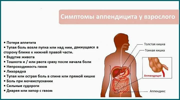 Первые симптомы аппендицита у женщины. Симптомы характерные для аппендицита. Специфические симптомы острого аппендицита. Признаки аппендицита у беременных. Симптомы при апендицыт.