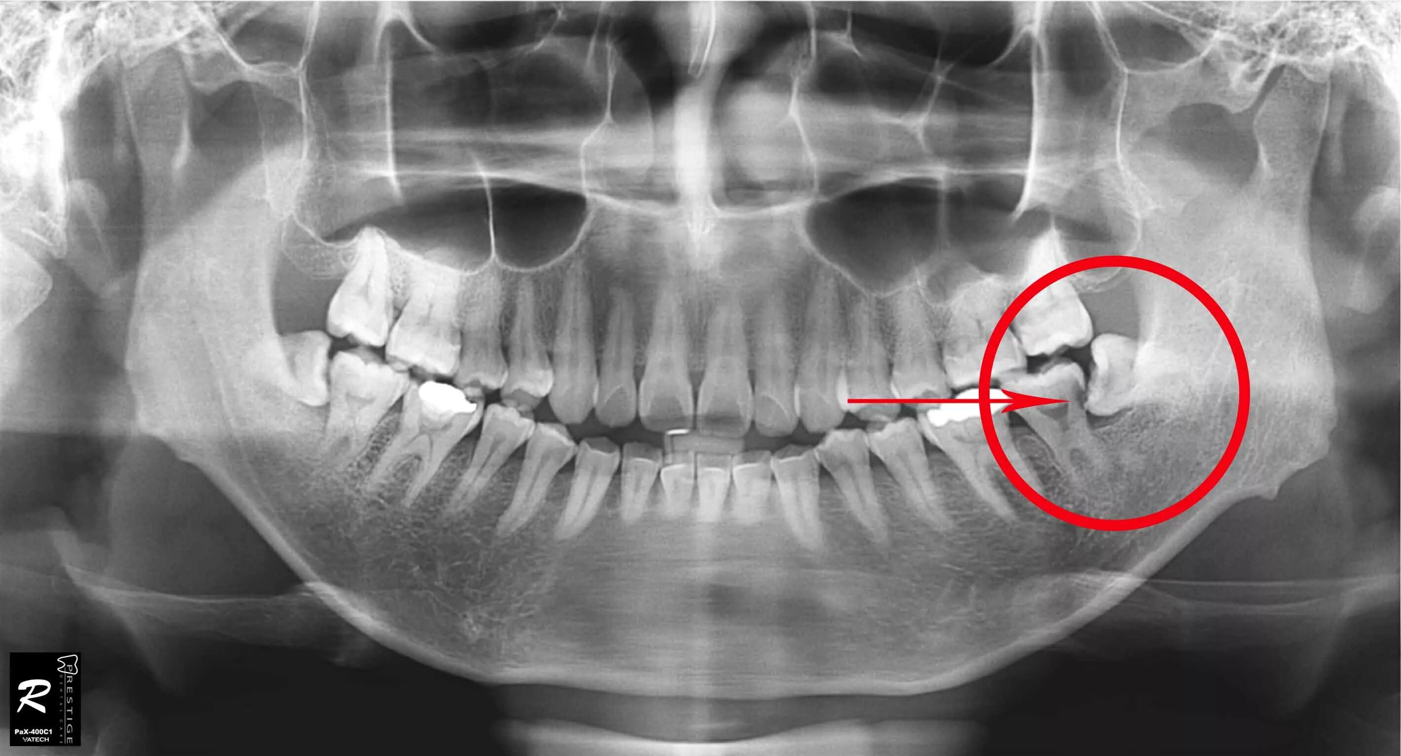 Лечат 8 зуб. Ретинированный зуб мудрости ОПТГ. Ретинированный зуб мудрости рентген. Ретинированный зуб мудрости верхней челюсти ОПТГ. Цифровая рентгенография ОПТГ зубных рядов.