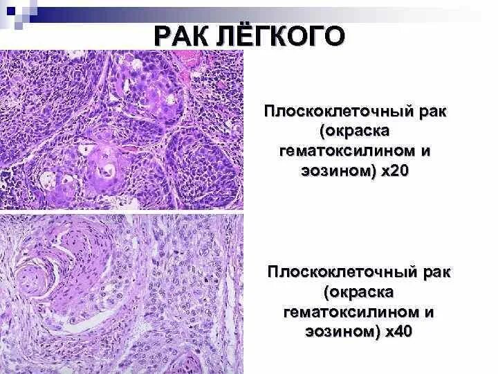 Плоскоклеточная карцинома легкого гистология. Плоскоклеточная карцинома кожи гистология. Плоскоклеточная карцинома легкого микропрепарат. Плоскоклеточная карцинома пищевода гистология. Умеренно дифференцированный плоскоклеточный рак