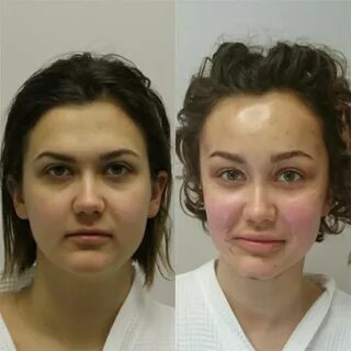 Операция убрать щеки