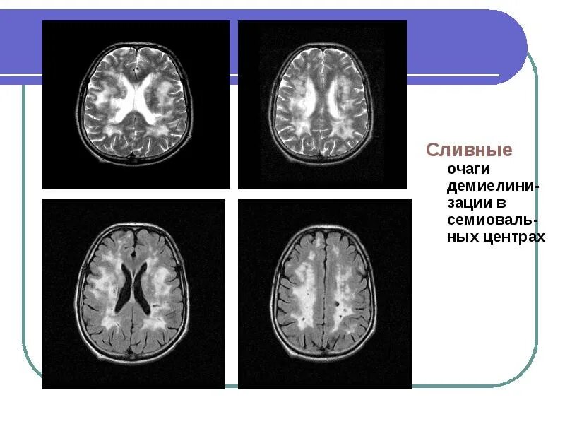 Лейкоэнцефалит