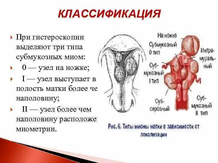 Лейомиома матки что это