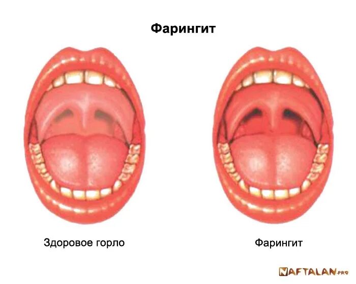 Асимметрия зева. Асимметрия зева