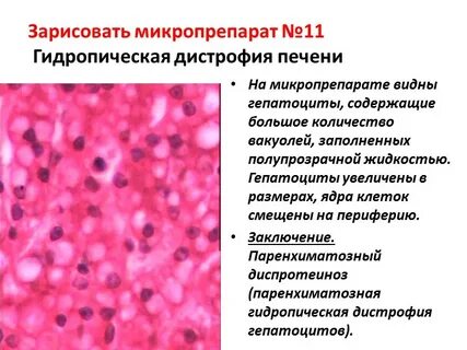 Белковая дистрофия печени