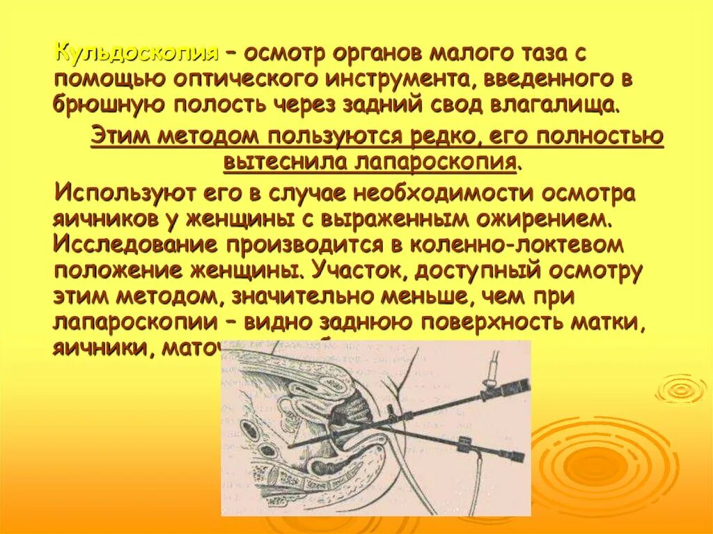Задний свод матки. Кульдоцентез и кульдоскопия. кульдоскопия инструменты. пункция заднего свода инструменты.