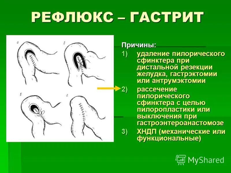 Атрофический рефлюкс. Поверхностный рефлюкс гастрит. Рефлюксный поверхностный гастрит. Причины рефлюкс гастрита.