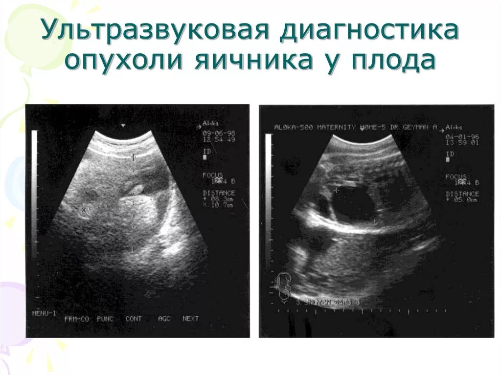 Доброкачественная опухоль яичника клинические. Диагностика опухолей яичников. Опухоль яичника диагностика. Диагностика доброкачественных опухолей яичников.