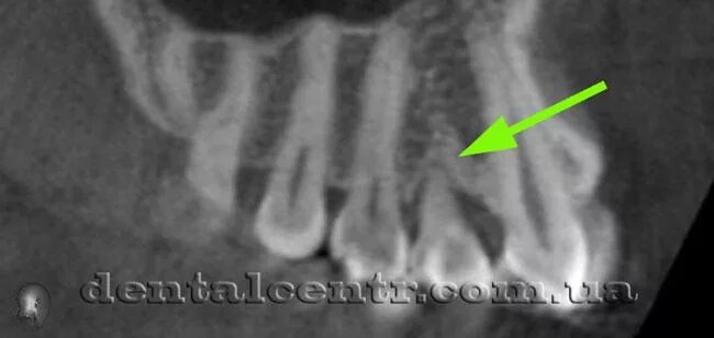 Резорбция корня зуба на снимке. Резорбция корня зуба на рентгене. Внутренняя резорбция корня зуба. Наружная резорбция корня на снимке.