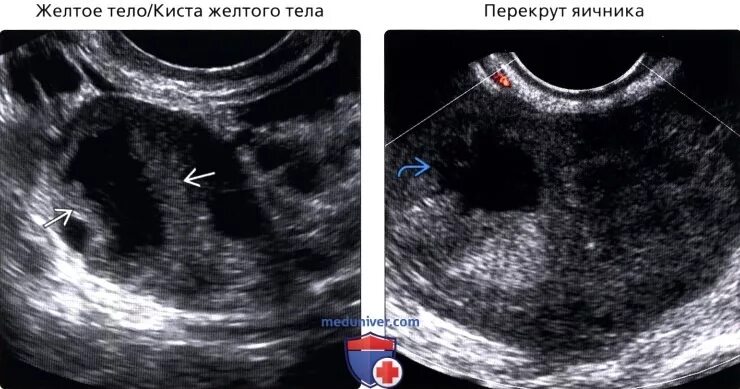 Фолликулярная киста яичника на УЗИ. Киста желтого тела яичника на УЗИ. Киста яичника с перегородками