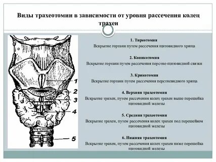 Трахеотомия
