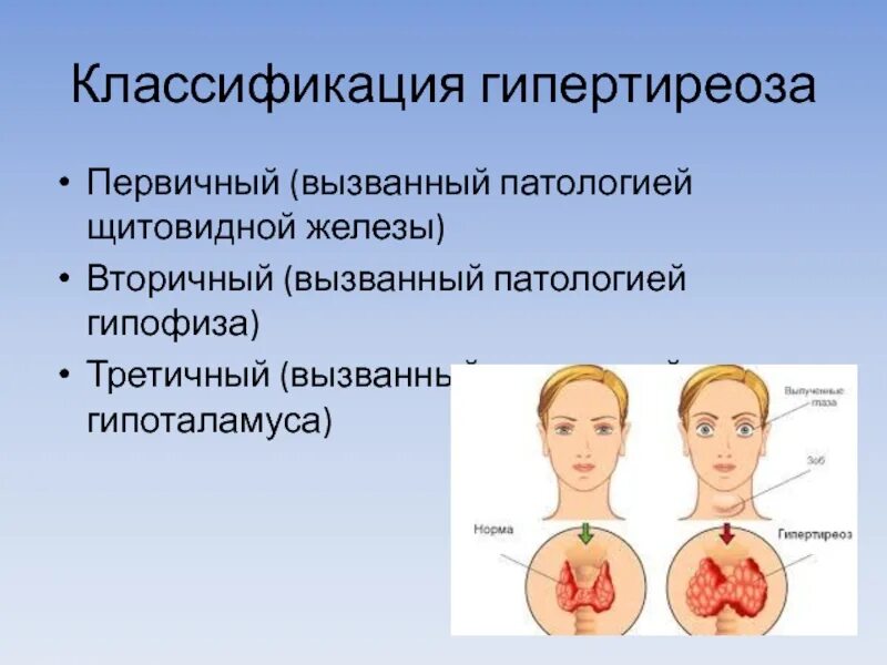 Гипертиреоз лечение у мужчин. Гипертиреоз классификация. Проявления гипертиреоза. Основные симптомы при гипертиреозе.