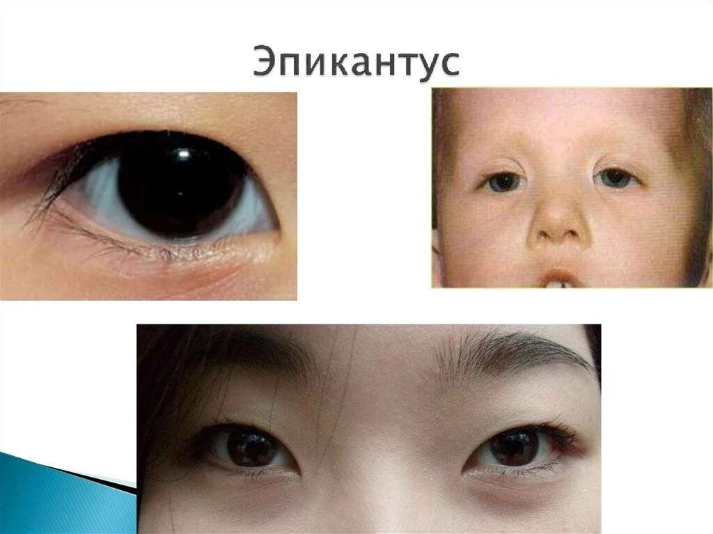 Узкие глаза признак. Монголоидная складка эпикантус. Эпикантус монгольская складка. Суперцилиарный эпикантус. Эпикантус БТС.