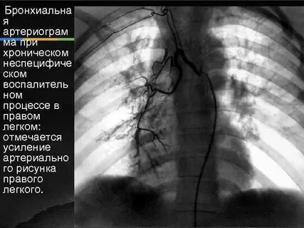 Вен правого легкого