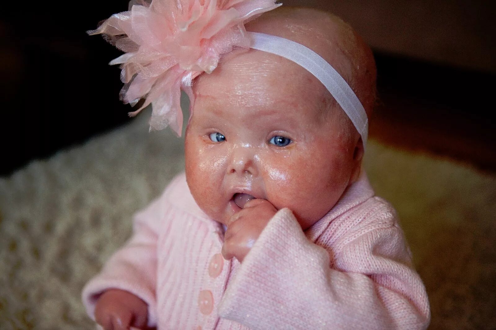 Ихтиоз арлекина новорожденный. Дети арлекины. Дети арлекины. Ихтиоз арлекино выжившие. Пабло пикассо поль в костюме арлекина.