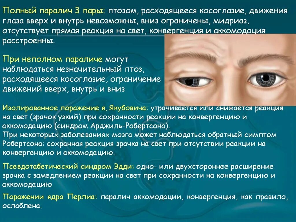 Расширенные зрачки не реагирующие на свет. Паралич аккомодации, птоз. Расходящееся косоглазие при поражении. Мидриаз и паралич аккомодации.