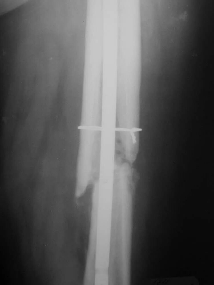 костная мозоль на плечевой кости. перелом бедра ложный сустав. ложный тазобедренный сустав рентген. остеосинтез чрезвертельного перелома. ложный сустав шейки бедренной кости.