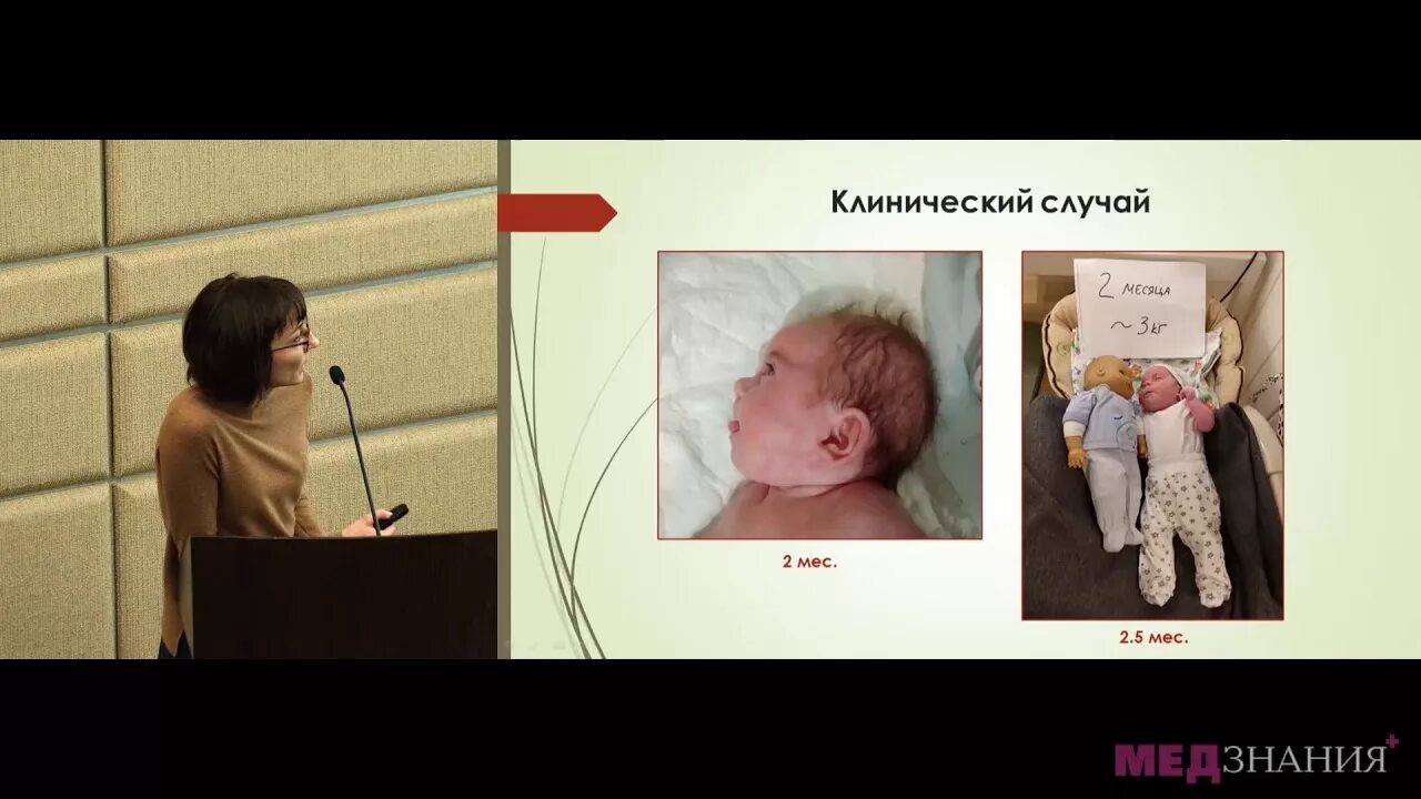 Синдром ля шапеля. Синдром амстердамской карликовости. синдром корнелии де ланге (амстердамская карликовость). синдром брахмана де ланге.