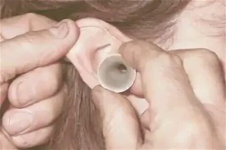 Ruptured eardrum (perforated eardrum)Treatment for eardrum rupture - YouTube