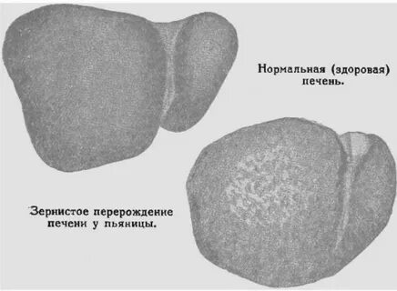 Печень крупнозернистая что значит
