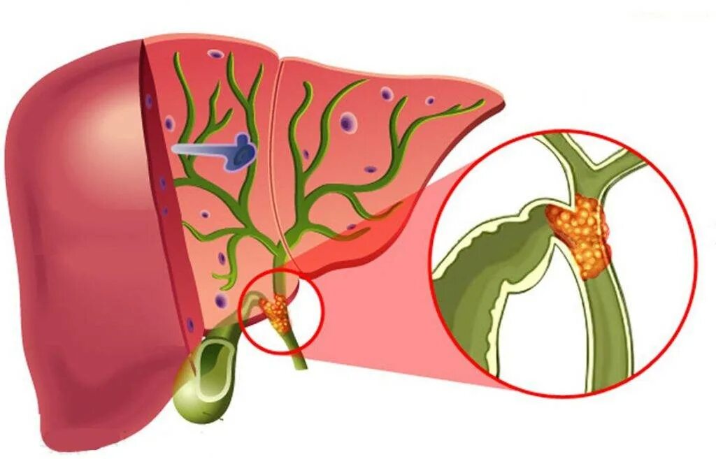Холангит желчных протоков. Холангит желчного пузыря. Острый холангит желчный пузырь. Заболевания желчных протоков