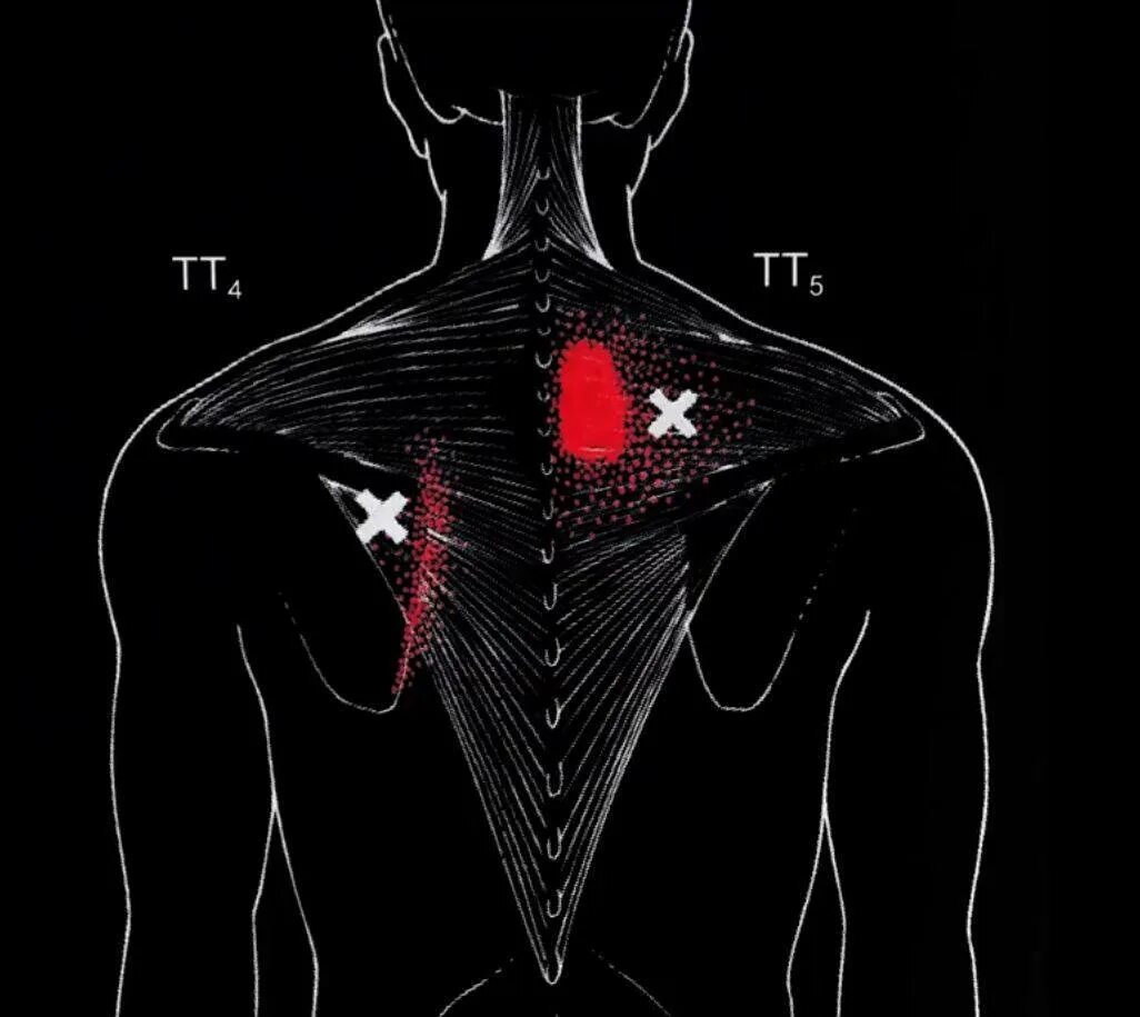 Болит между лопатками. Мышца между лопаткой и позвоночником. Боль под лопаткой. Болит под лопаткой. Болит под правой лопаткой у мужчины