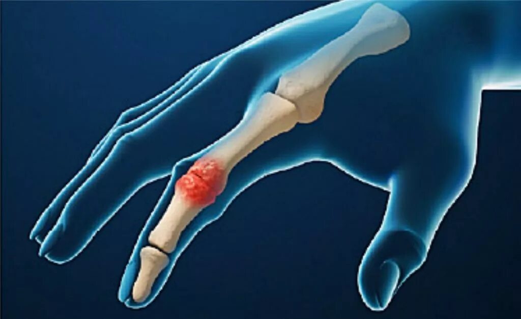 Острый ревматический полиартрит это. Ревматоидный артрит запястного сустава.