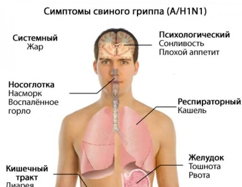 Симптомы желудочного гриппа у взрослых и лечение. Свиной грипп. Свиной грипп симптомы. Симптомы гриппа. Проявление свиного гриппа.