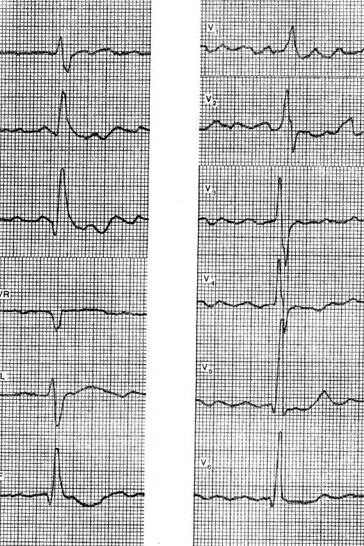 Гипертрофия обоих желудочков на ЭКГ. Поворот сердца правым желудочком ЭКГ. ЭКГ при поворотах сердца вокруг продольной оси. Поворот сердца верхушкой кзади на ЭКГ. Поворот правым желудочком вперед