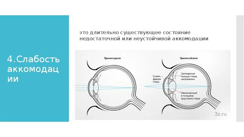 Ли спазм аккомодации. Аккомодация. Нарушение аккомодации. Коррекции нарушений аккомодации. Слабость аккомодации у детей.