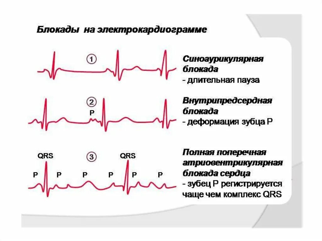 Блокада qrs. Внутрипредсердная блокада на ЭКГ. Атриовентрикулярная блокада классификация. ЭКГ при внутрипредсердной блокаде. АВ блокада классификация.