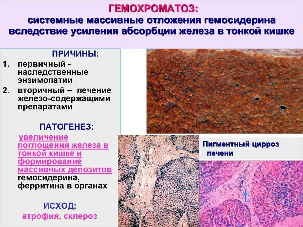 Основной клинический признак первичного гемохроматоза:. Гемохроматоз этиология патогенез. Печень при гемохроматозе макропрепарат. Гемохроматоз печени этиология.