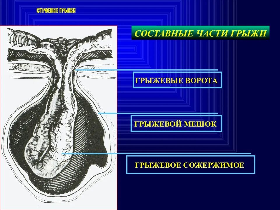Строение мешочков. Структурная анатомия грыжи. строение грыжевого мешка.