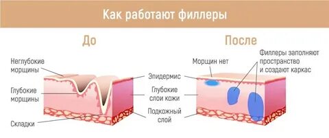 После введения филлера нельзя