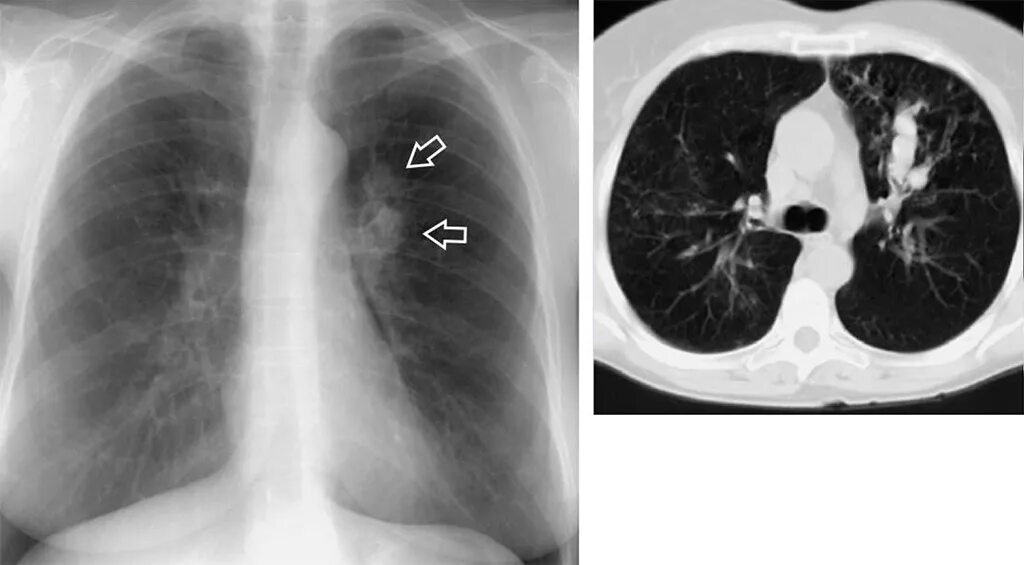 септическая пневмония на кт. лейомиоматоз легких на кт. воздушная киста в легком на кт. фиброзно-кавернозный туберкулез кт. буллезная пневмония на кт.