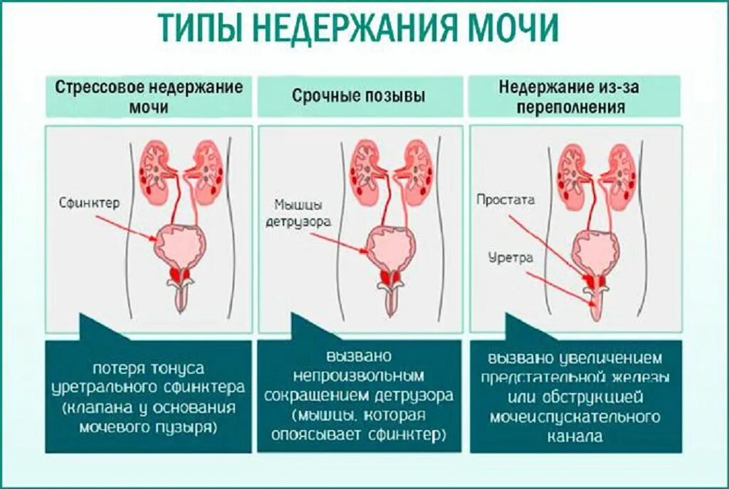 Гипотония мочевого пузыря. Недержание мочи. Типы недержания мочи. Причины недержания мочи. Недержание мочи у женщин.