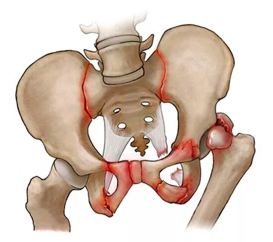 Костный мозг подвздошной кости. Сакроилеит тазобедренного сустава. Сакроилеит крестцово-подвздошного. Сакроилеит крестцово-подвздошного сочленения.