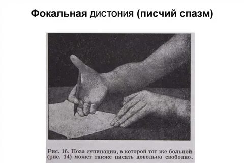 Писчий спазм