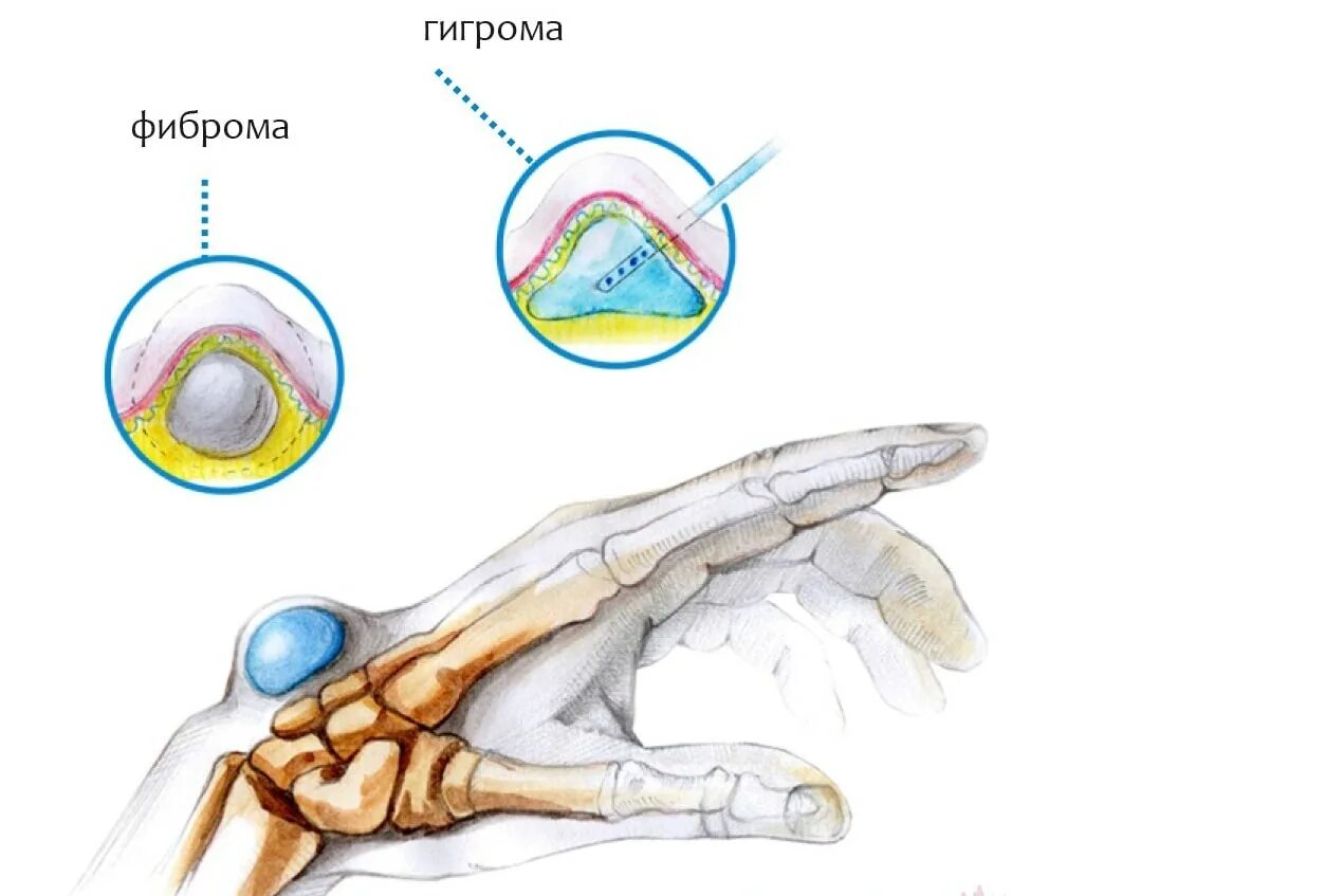 Гигрома запястья (лучезапястного сустава). Гигрома лучезапястного сустава анатомия. Гигрома лучезапястного сустава руки. Гигрома межфалангового сустава.