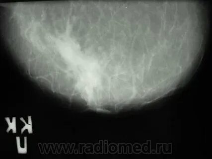 Гематома молочной железы