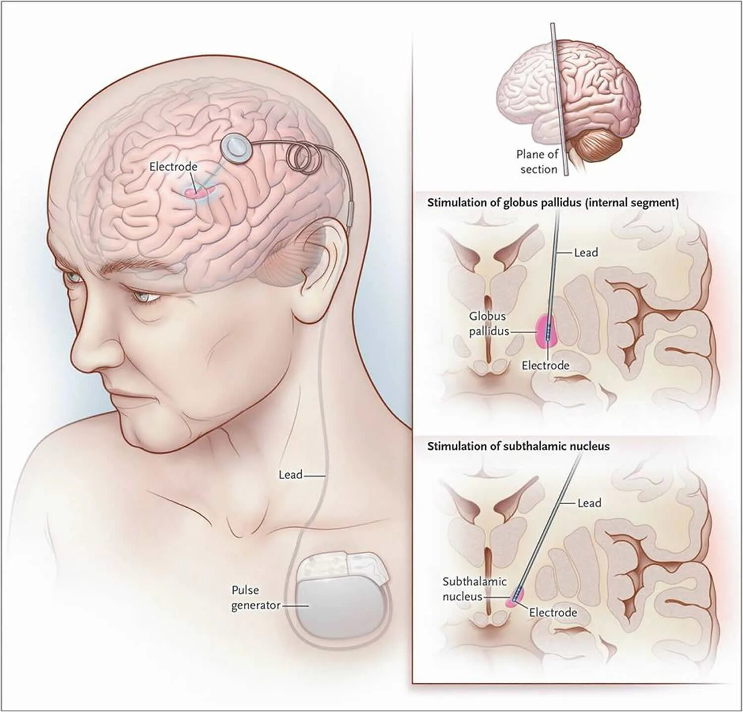 Deep brain. Глубокая стимуляция мозга. Нейростимулятор мозга операция. Операция глубокая стимуляция мозга.