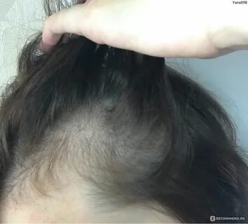 Почему не выпадают волосы после лазерной