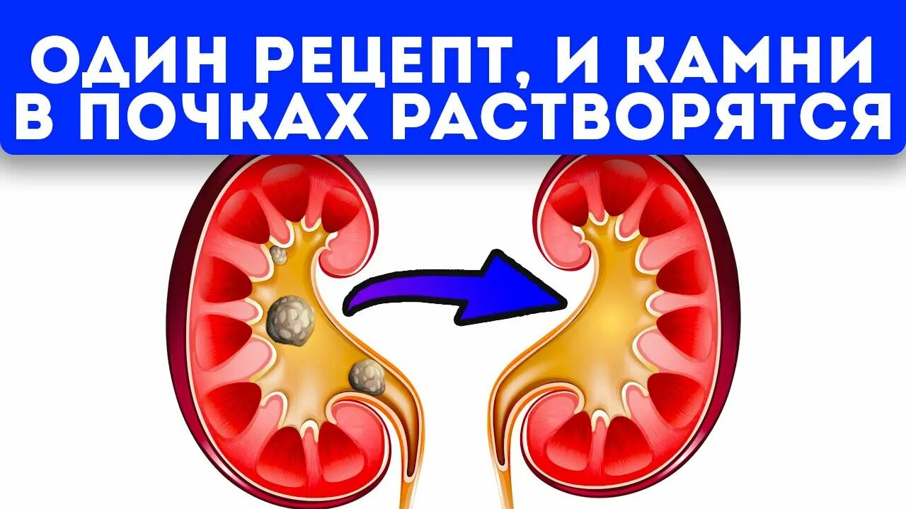 Препараты растворяющие почечные камни. Растворение почечных камней.