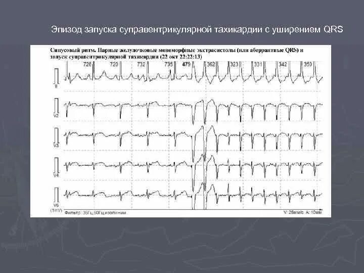 Тахикардия qrs. Умеренная синусовая тахикардия. суправентрикулярная тахикардия комплекс qrs. уширение qrs.