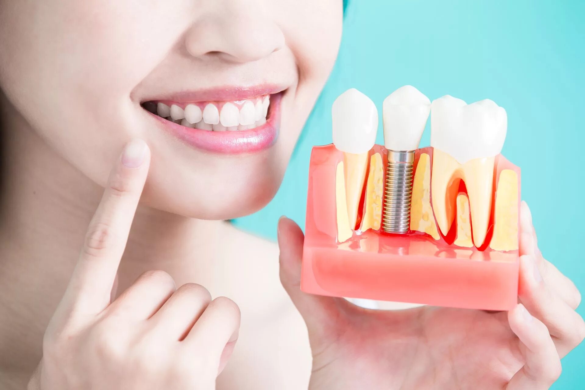 Dental implantation. Dental implantation. Dental implantation. Имплант зуба osstem. Dental implantation.